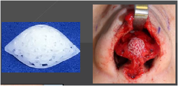 Anatomic Tipball Position